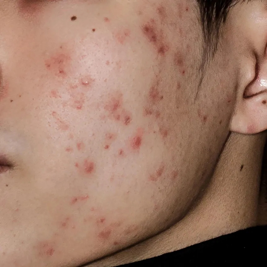 Common Acne Treatment Can Have Unintended Life-Long Effects on the Skeleton